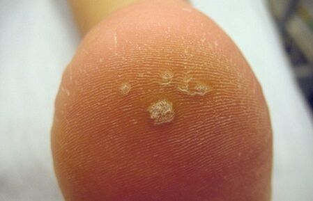 Hogyan lehet felismerni egy Pierce szemölcsöt