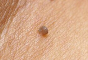 A papilloma klinikai képe