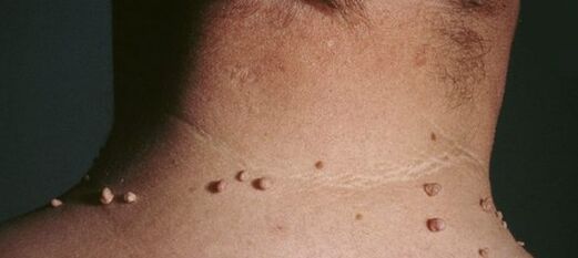 hogyan lehet megszabadulni a papillómáktól