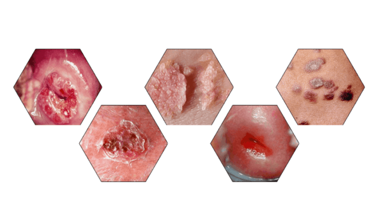 miért veszélyesek a papillómák