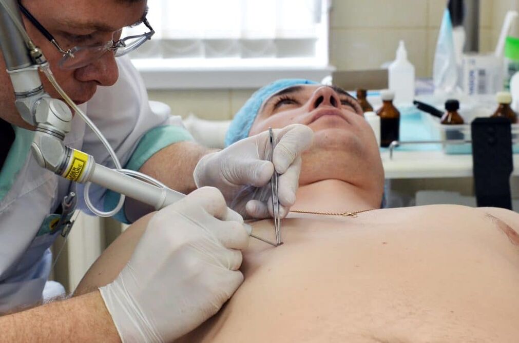 hogyan lehet megszabadulni a szemölcsöktől a testen