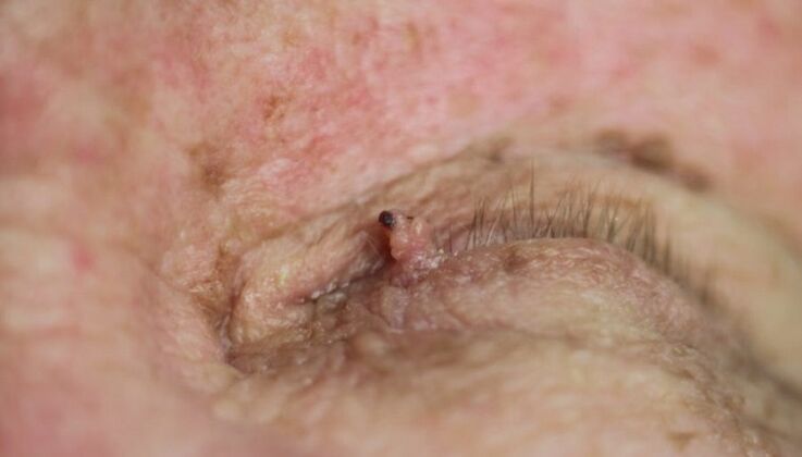 papilloma a szemhéjon hogyan lehet megszabadulni tőle
